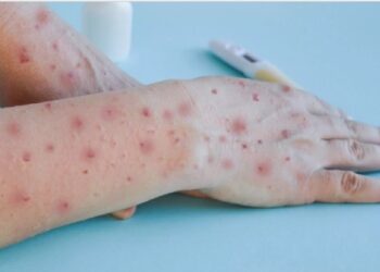 OMS declaró Emergencia Internacional a la Viruela del Mono