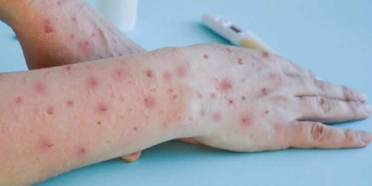 OMS declaró Emergencia Internacional a la Viruela del Mono