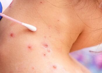 Viruela Símica: Dos nuevos casos detectados