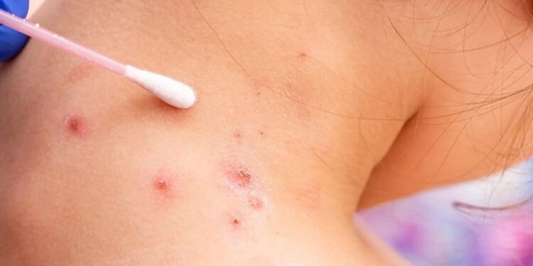 Viruela Símica: Dos nuevos casos detectados