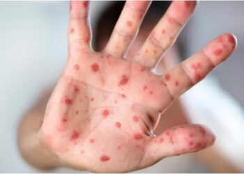 Viruela del Mono: Alertan sobre casos de lesiones en la piel