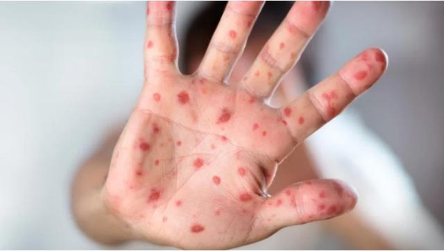 Viruela del Mono: Alertan sobre casos de lesiones en la piel
