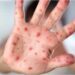 Viruela del Mono: Alertan sobre casos de lesiones en la piel