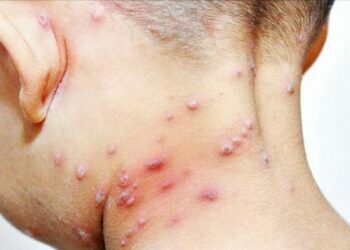 Suman 133 casos positivos de Viruela del Mono en el país