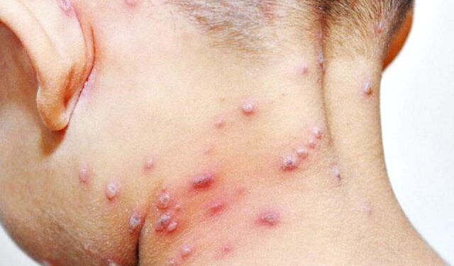 Suman 133 casos positivos de Viruela del Mono en el país