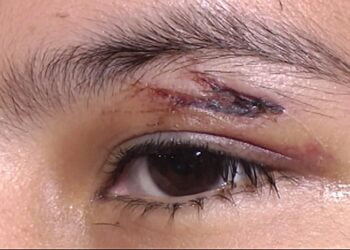 Bullyng: “Casi pierde el ojo en un ataque”