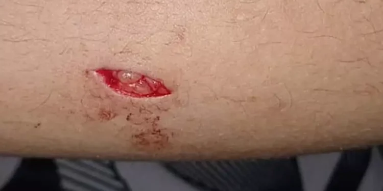 Atacan con arma blanca a un joven y su novia